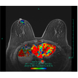 clínica de exame de imagem ressonância magnética de mama Santana