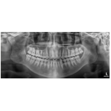 clínicas para exame de tomografia dental barata Vila Ré