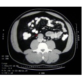 exame de imagem de tomografia do tórax barato Belém