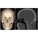 Tomografia do Crânio com Contraste
