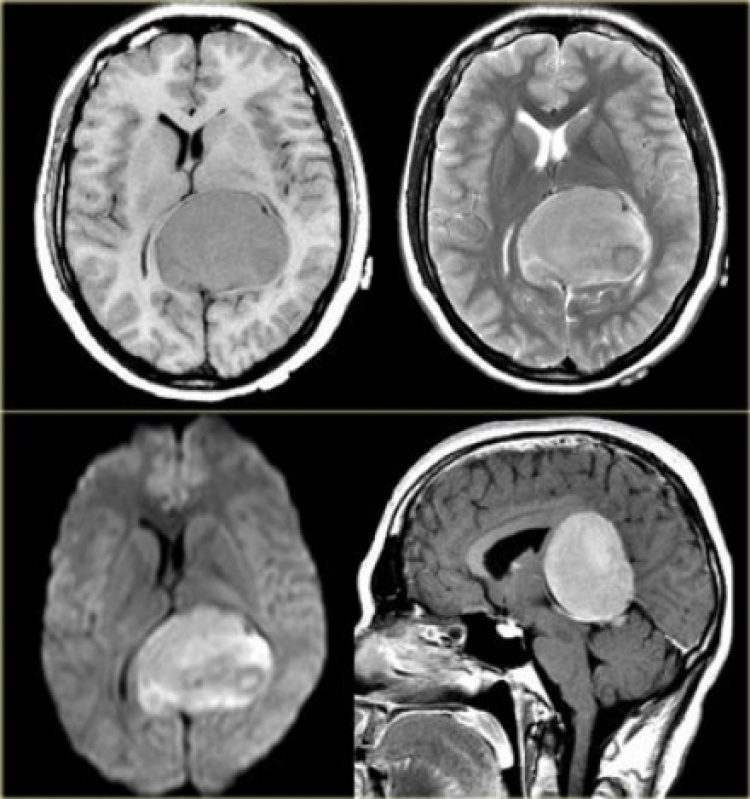 Tomografia do Crânio com Contraste Preço Porto da Igreja - Tomografia para Tumor Cerebral